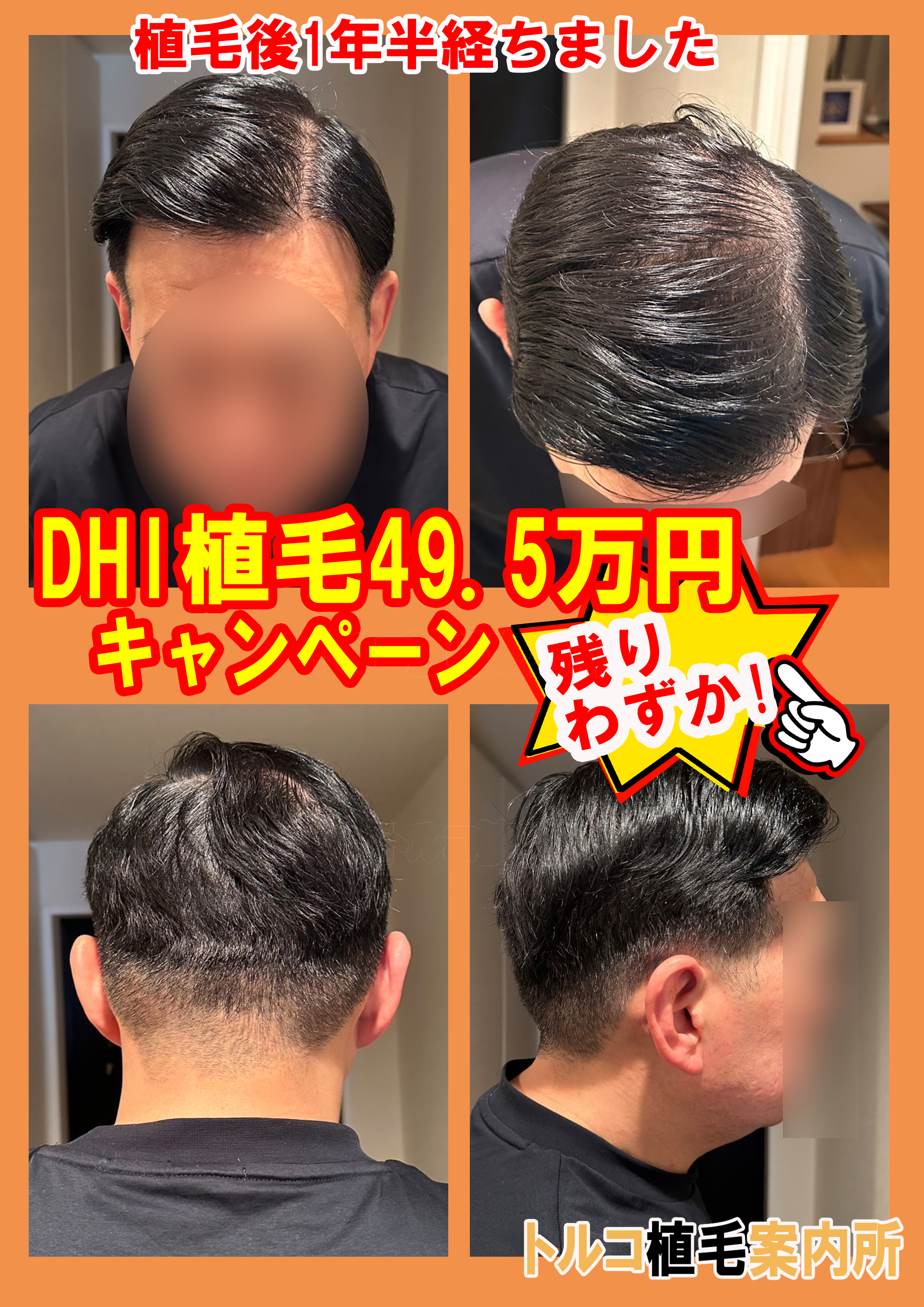 植毛後1年半経ちました 